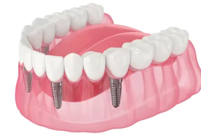 All on 4 İmplant