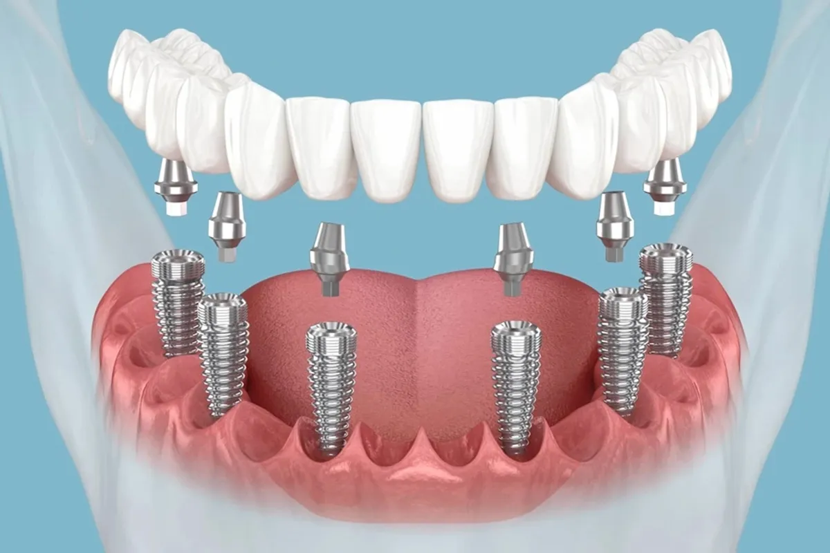 All on 6 Implants