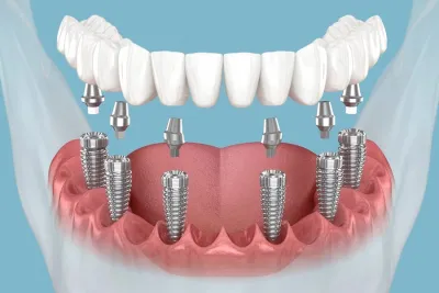 All on 6 İmplant