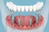 All on 6 Implants