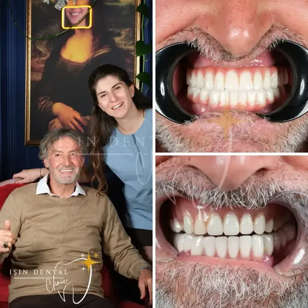 Dental treatment before and after - Isin Dental Clinic