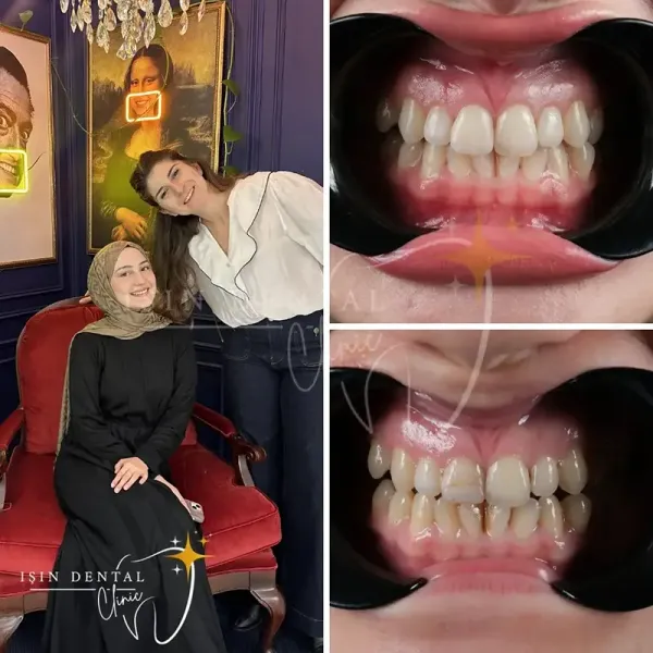 Smile design before and after - Isin Dental Clinic