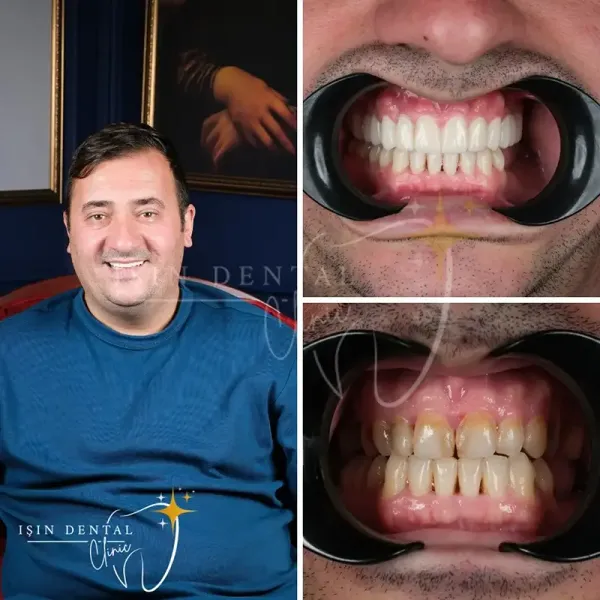 Dental implants before and after - Isin Dental Clinic