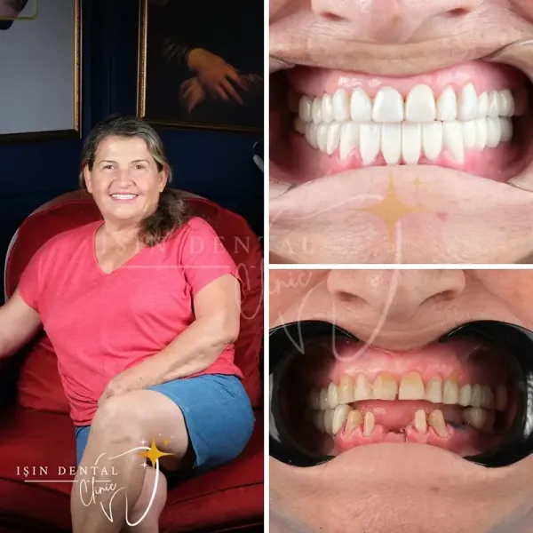 Teeth whitening before and after - Isin Dental Clinic