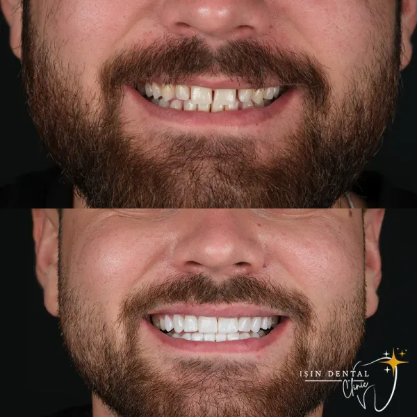 Before and After Treatment 9