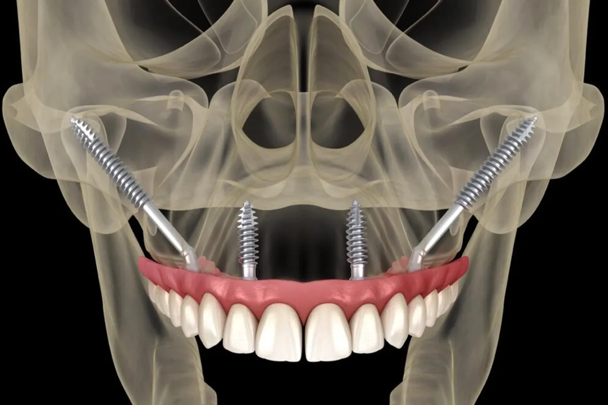 Zygomatic Implants